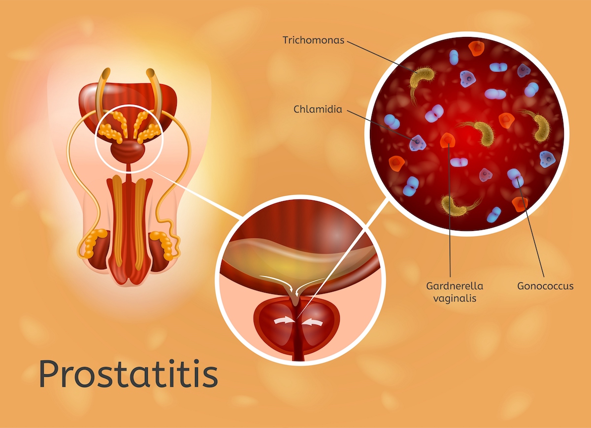 Prostatitis Problem Acute Prostatitis: Symptoms, Causes & Treatment | Dr. Soarawee Urology